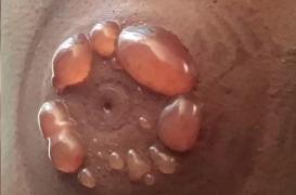 Elle s'endort pendant un massage aux ventouses et se retrouve couverte d'ampoules 