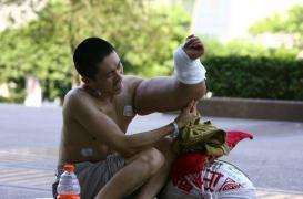 Angiomes : un traitement médicamenteux change la vie des patients