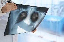 Cancer du poumon : la HAS fait un pas vers le dépistage