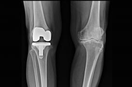 Au CHU de Lille, un robot pour poser les prothèses du genou