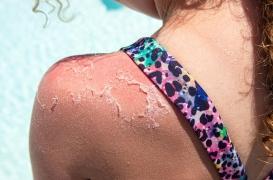 Coup de soleil : quand faut-il le traiter comme une brulûre ?