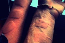 Ice and Salt Challenge : le défi qui brûle la peau des adolescents