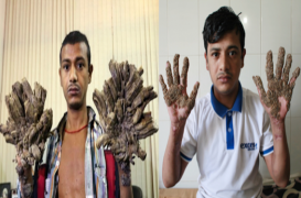 Abul Bajandar : l'homme arbre a subi 16 opérations