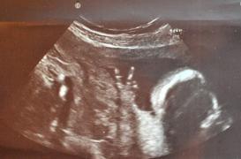 La sélection du sexe à la naissance gagne l’Europe de l’Est