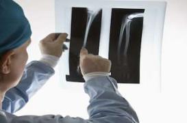 Réparer des fractures avec des vis en soie