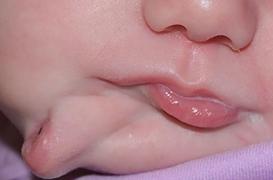 Diprosopie : un bébé naît avec deux bouches et deux langues