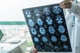 Suède : une famille touchée par une nouvelle forme d’Alzheimer 