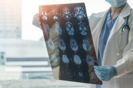 Maladie d'Alzheimer : une mutation récemment découverte augmente les risques