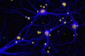 Alzheimer : la protéine BRCA1 liée aux troubles de la mémoire