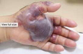 Il est amputé de la main après avoir mangé dans un restaurant de sushis. Explications