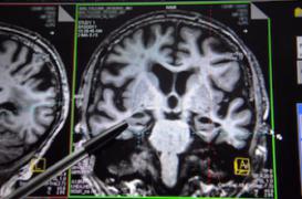 Mort subite de nourrisson : une anomalie cérébrale identifiée