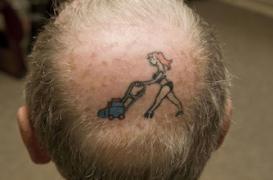  Calvitie: une technique innovante pour faire repousser les cheveux