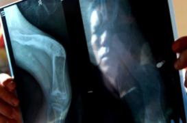 Maladie des os de verre : la protéine à l’origine de la fragilité