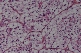 Cancer du rein : avancées majeures avec 2 molécules 