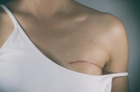 Les médicaments contre le reflux acide ont des effets secondaires sur les survivantes du cancer du sein