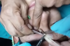 Des feuilles de basilic pour retirer une larve d'un œil 