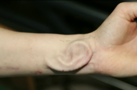 Une greffe d'oreille cultivée sur l'avant-bras d'une patiente