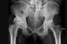 Il est examiné pour une douleur au genou : en fait, c'est son pénis qui se transforme en os 