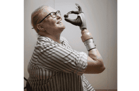 Comment une main bionique a pu stopper les douleurs du membre fantôme