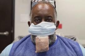 Formes graves de la Covid-19 : il se réveille avec une langue énorme après avoir été placé en coma et allongé sur le ventre