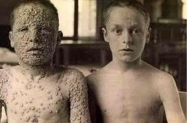 Variole  : oui, cette photographie choc attestant des bienfaits du vaccin est vraie