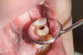 Caries dentaires : une nouvelle bactérie responsable identifiée