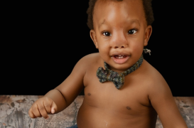 Jayden Moyo : né avec le cerveau à l'extérieur du crâne