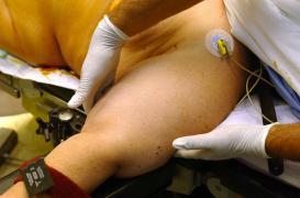 Obésité : la chirurgie augmente la survie à long terme