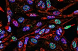 Cancer de la vessie : une nouvelle technique non invasive pour le détecter