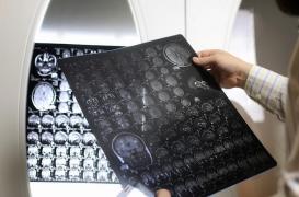 Fibromyalgie : le débit sanguin cérébral serait altéré 