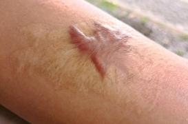 La délicate prise en charge des cicatrices chéloïdes