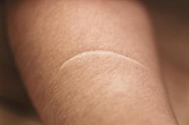 On pourra bientôt soigner une plaie sans laisser de cicatrices