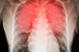Covid-19: d’où viennent les lésions pulmonaires dont souffrent certains malades?