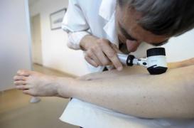 Dépistage du mélanome: l'INCa pointe les failles