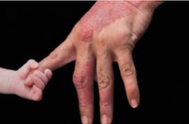 Psoriasis : un traitement par anticorps prometteur