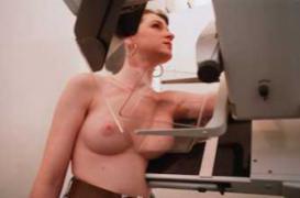 Cancer du sein : une avancée 