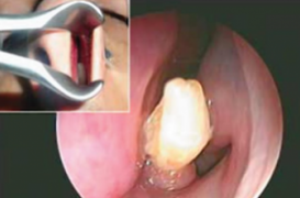 Un Saoudien a vécu plusieurs années avec une dent dans le nez 