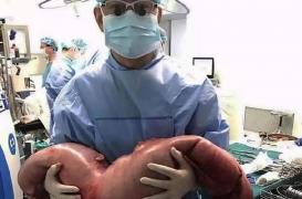 Chine : les médecins lui retirent 13 kg de matières fécales du ventre
