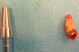 Il peine à respirer et perd l'odorat à cause d'une dent qui lui poussait dans le nez