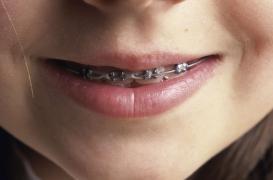 Appareils dentaires : le 