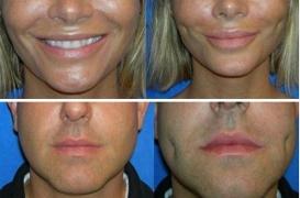 Chirurgie esthétique : la nouvelle mode des fossettes aux États-Unis