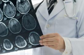Subir un traumatisme crânien augmente le risque d’AVC