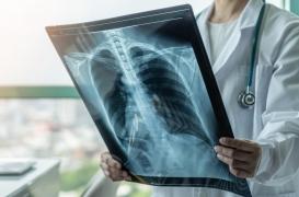 Covid-19 : quelles sont les conséquences à long-terme sur les poumons ? 