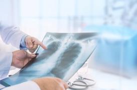 Une association signale des cas de migration d’implants contraceptifs dans les poumons 