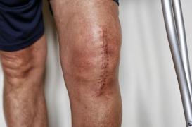 L'intelligence artificielle peut prévoir les douleurs intenses et éviter la dépendance aux opioïdes