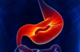 Helicobacter pylori, la bactérie responsable des ulcères et des cancers de l'estomac