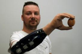PREMIERE. Une main bionique aussi efficace qu’une greffe