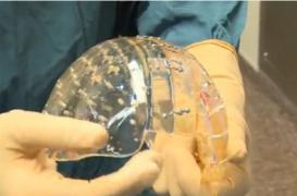1ère mondiale : un crâne humain remplacé par une impression 3D 