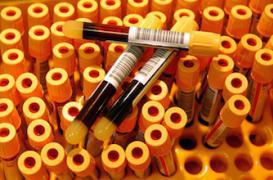 Sida : les experts militent pour un dépistage sous toutes ses formes 