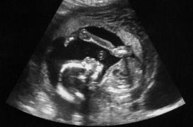 Un algorithme est capable de détecter certaines formes d’autisme avec 100% de réussite